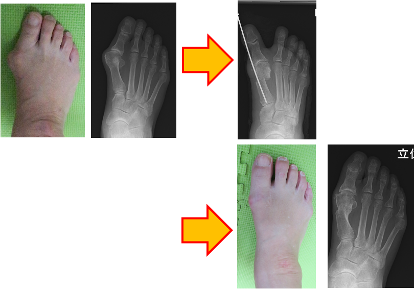 足に関する疾患 | 金沢大学附属病院整形外科